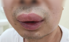 “五毒”伴夏而来 快收下这份防“毒”指南